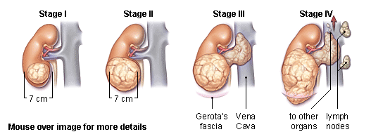 kidney_cancer_stage